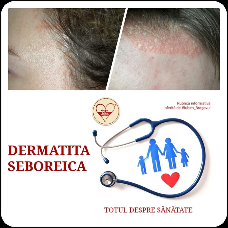 Ready alignment Practical Dermatita seboreica – Iubim Brasovul